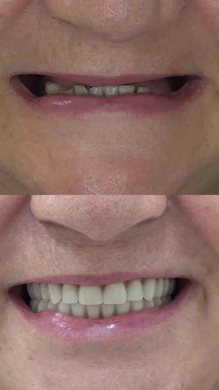 Registro de antes e depois de reabilitação oral fornecido pela unidade Mandacaru