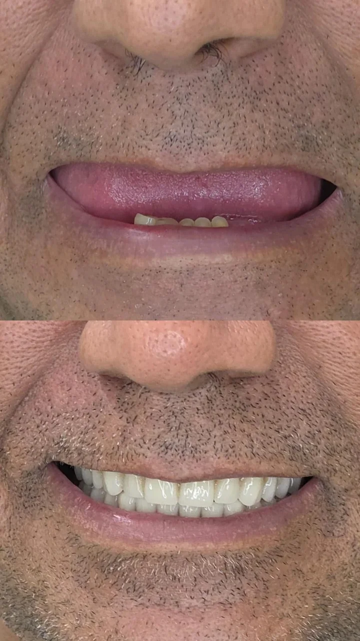 Registro de antes e depois de tratamento com implantes fornecido pela unidade Mandacaru
