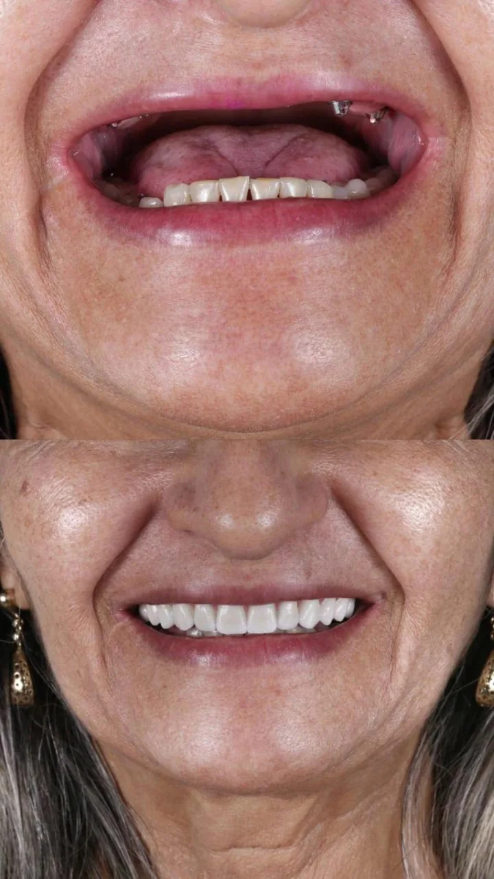Registro de antes e depois de reabilitação com implantes fornecido pela unidade Mandacaru